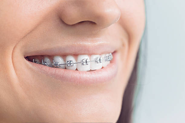 Dental Bonding in Pico Rivera, CA